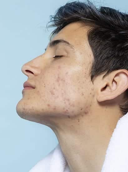 Acne Vulgaris Treatment in Chennai