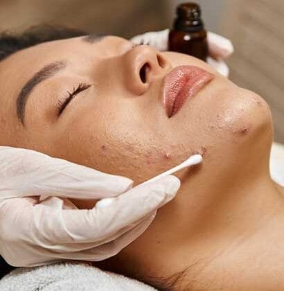 acne treatment in Chennai