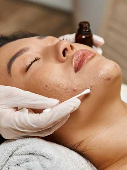 acne treatment in Chennai