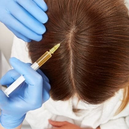 best PRP hair treatment in Chennai