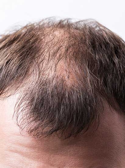 best-alopecia-treatment-in-nungambakkam