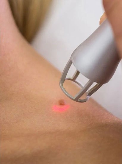 best-mole-removal-treatment-in-nungambakkam