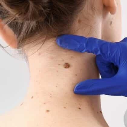 best skin tag removal treatment in Chennai