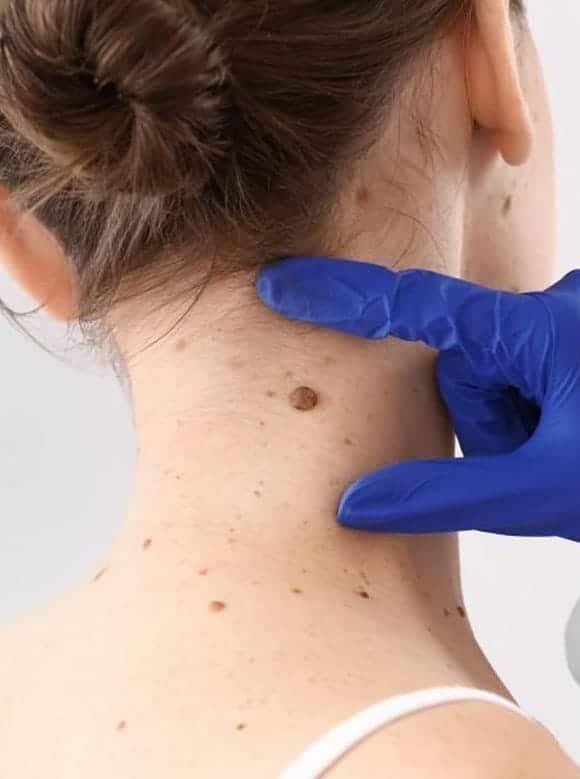 best skin tag removal treatment in Chennai
