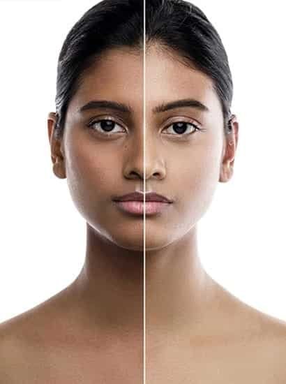 Best Treatment for Dull Skin in Chennai