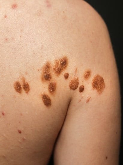 birthmark treatment in Chennai