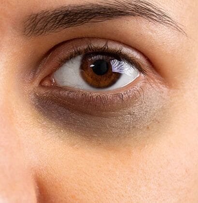 Dark Circle Treatment in Nungambakkam