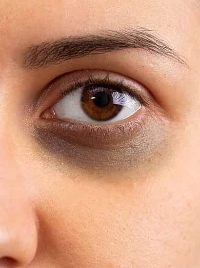 Dark Circle Treatment in Nungambakkam