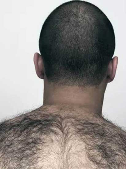 Hypertrichosis treatment in Chennai
