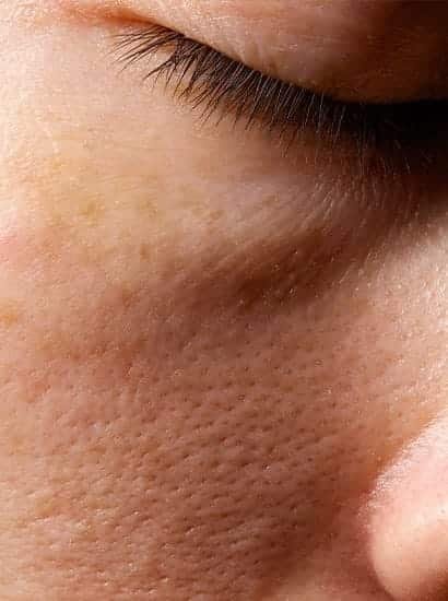 open pores treatment in Chennai