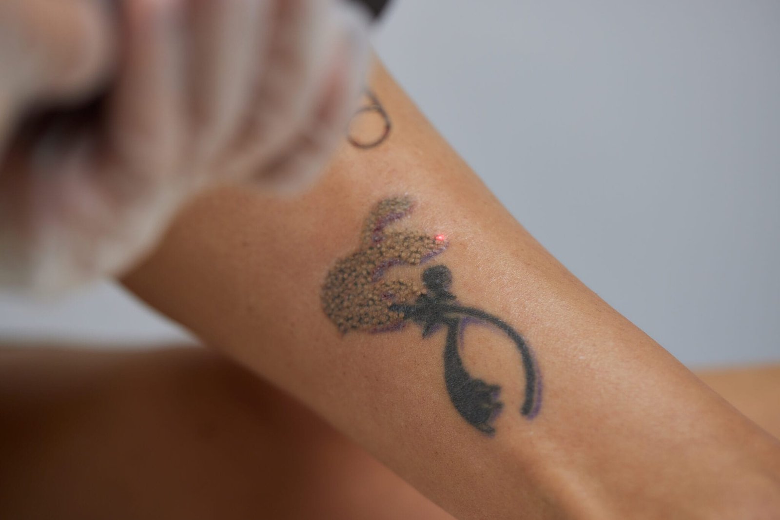 Permanent Tattoo Removal Treatment