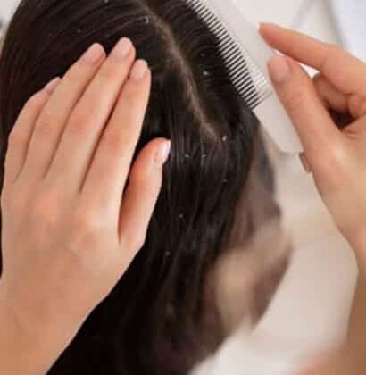 best dandruff treatment in chennai
