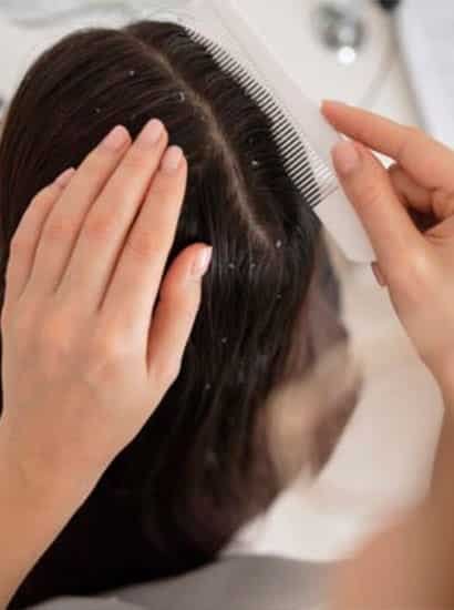 best dandruff treatment in chennai