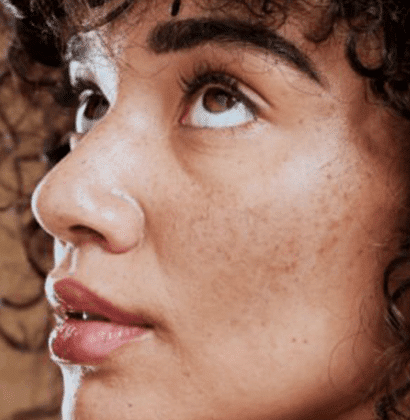 best melasma treatment in chennai