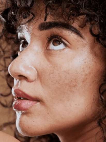 best melasma treatment in chennai