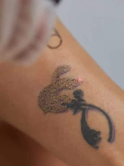 best tattoo removal treatment in nungambakkam