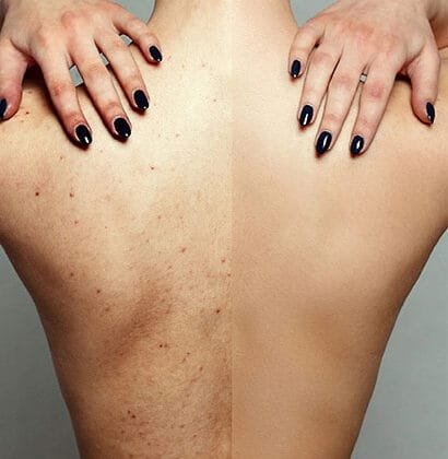 best body peel for pigmentation