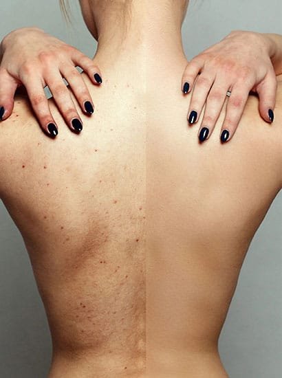 best body peel for pigmentation