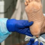 crack heel treatment