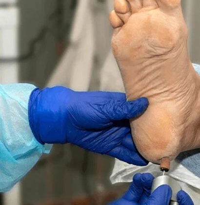 crack heel treatment