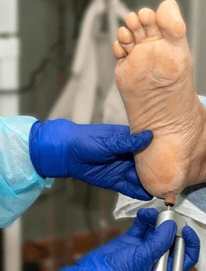 crack heel treatment