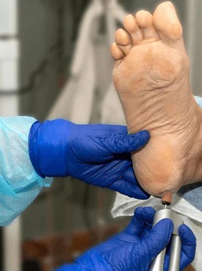 crack heel treatment