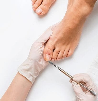 Nail fungus (onychomycosis) is a common condition that causes discoloration, thickening, and brittleness of the nails. It typically affects toenails more than fingernails and is caused by fungal infections that thrive in warm, moist environments.