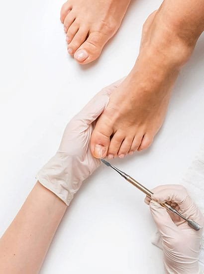 Nail fungus (onychomycosis) is a common condition that causes discoloration, thickening, and brittleness of the nails. It typically affects toenails more than fingernails and is caused by fungal infections that thrive in warm, moist environments.