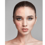 melasma treatment in dermea