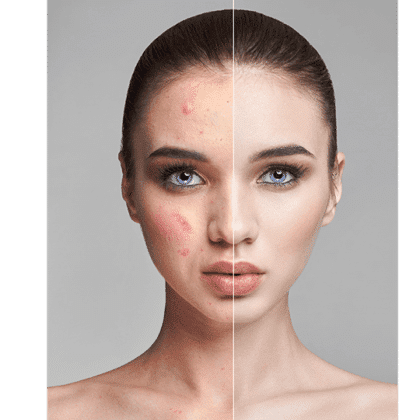 melasma treatment in dermea