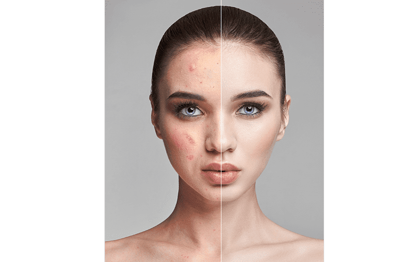 melasma treatment in dermea