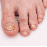 Nail Fungus treatment