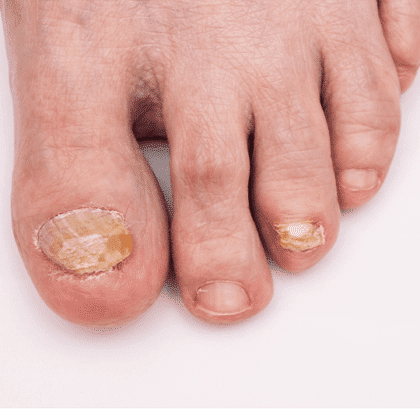 Nail Fungus treatment