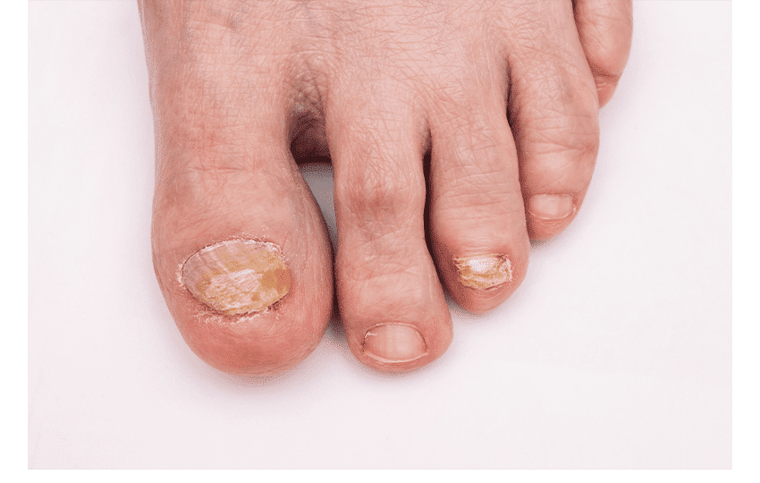 Nail Fungus treatment