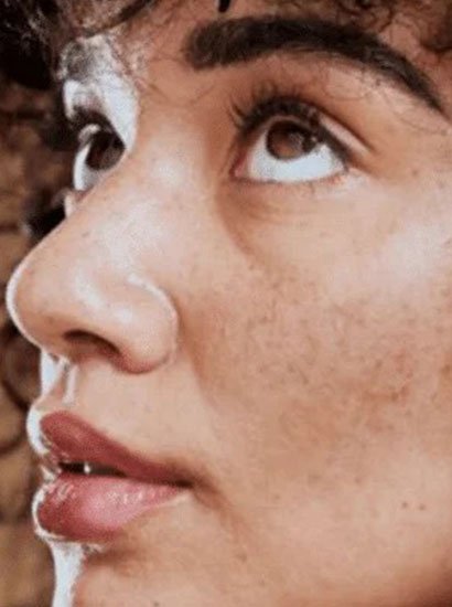 best melasma treatment in chennai