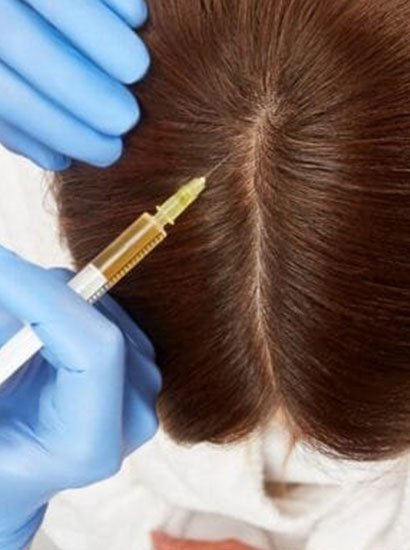 best prp hair treatment in chennai